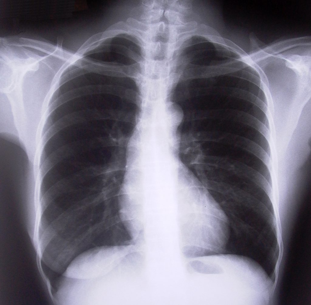 chest-xray-1526779-1024x1004