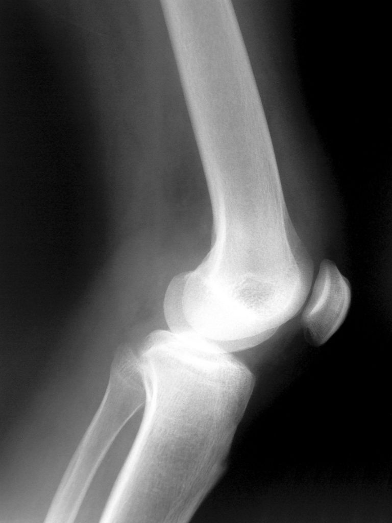 knee-x-ray-2-1562058-768x1024