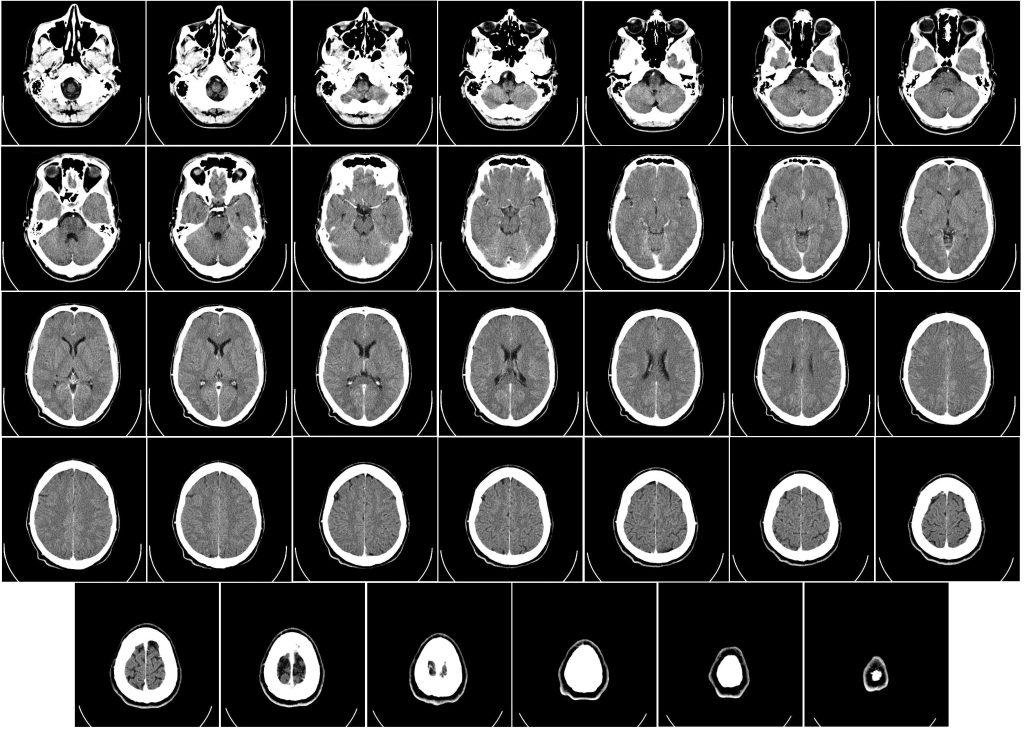 computed_tomography_human_brain-1024x730